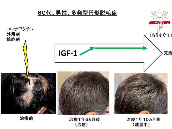 円形脱毛症　病院